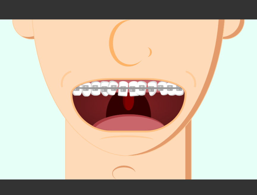 牙齿矫正动画演示牙根设计，牙齿卡通动态图片素材